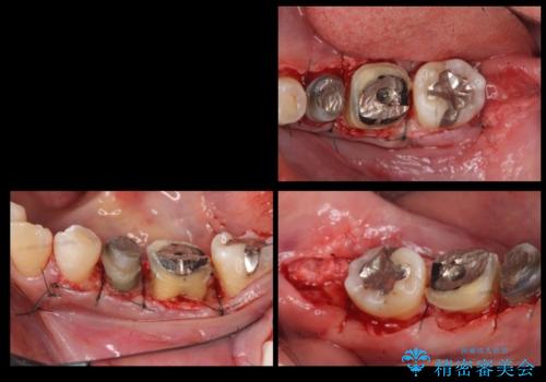 歯の高さがない 被せ物のやりなおしの治療中