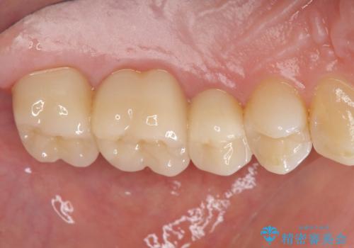 歯の神経を守る、精密な虫歯治療の実践の治療後