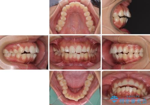 口が閉じられない 抜歯矯正で横顔の印象が劇的に変化の治療前