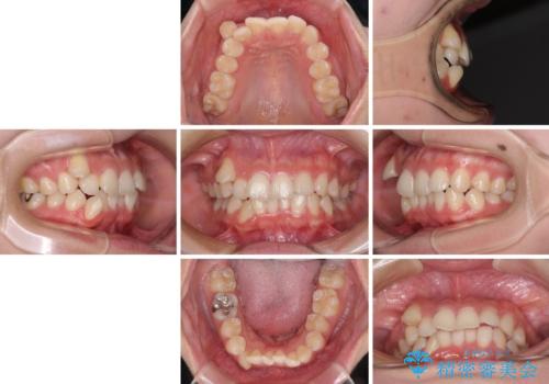 八重歯の抜歯矯正 補助装置とワイヤーを併用したインビザライン矯正治療の治療前