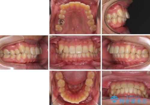 遠方からの通院 インビザライン矯正治療の治療前