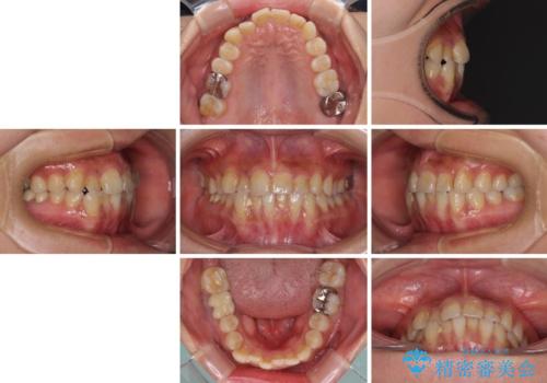 前歯のデコボコとクロスバイト　インビザラインによる矯正治療の治療前
