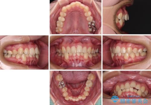 前歯のクロスバイト ギラギラのワイヤー装置で矯正治療の治療前