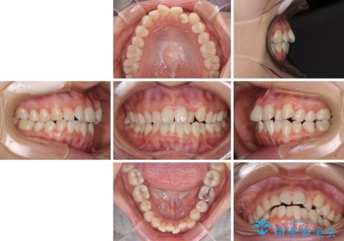 抜歯矯正へ切り替え　表側のワイヤー矯正の治療前