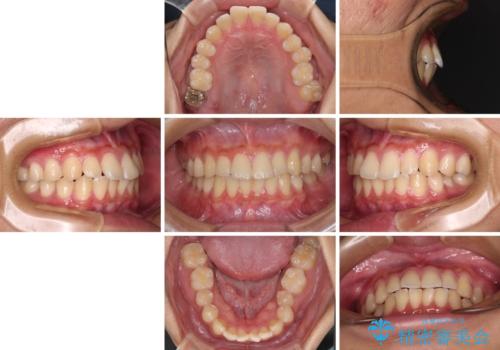 抜歯が必要な奥歯と前歯のデコボコ　インプラント治療とインビザライン矯正治療の治療前