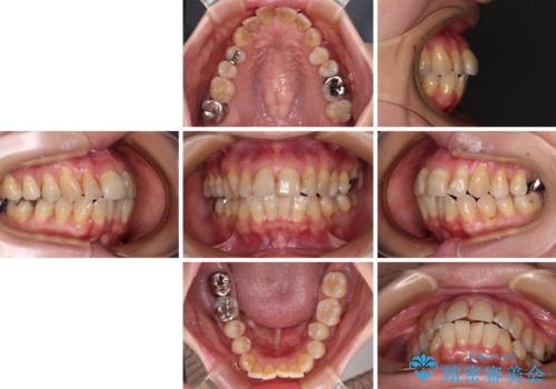 【モニター】前歯の突出感を抜歯矯正で改善の治療前