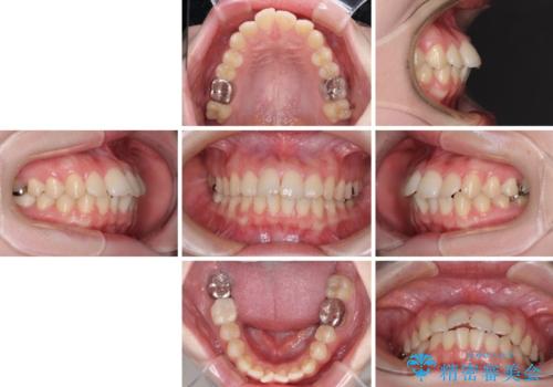 デコボコ歯列をきれいに インビザラインによる矯正治療の治療前
