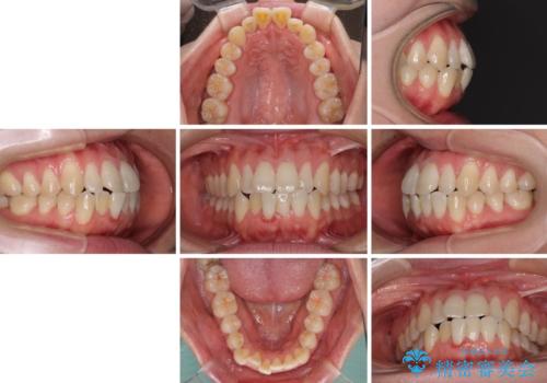 膨らんだ口元をスッキリと ワイヤー装置での抜歯矯正の治療前