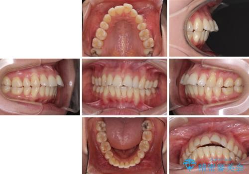 後戻りで突出した口元を引っ込めたい インビザライン矯正治療の治療前