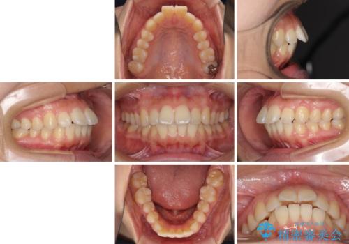 前に出ている前歯を引っ込めたい インビザライン矯正の治療前