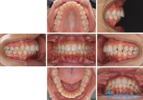 閉じにくい唇 抜歯矯正でスッキリした横顔にの治療前