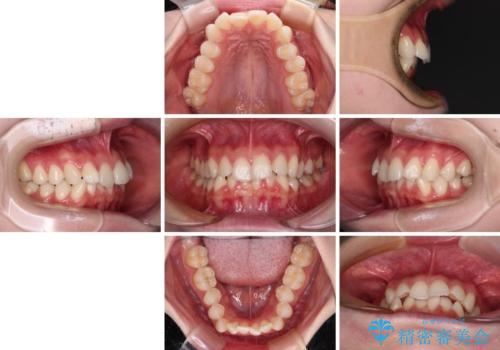 前歯のデコボコと深い咬み合わせ インビザラインできれいに改善の治療前