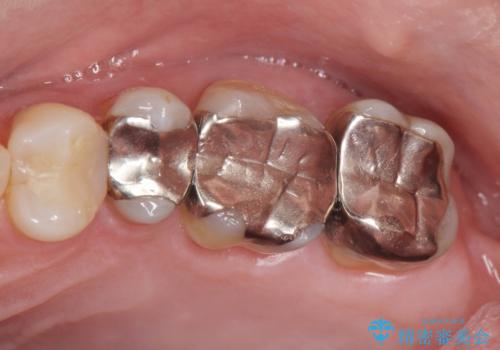 歯の神経を守る、精密な虫歯治療の実践の治療前