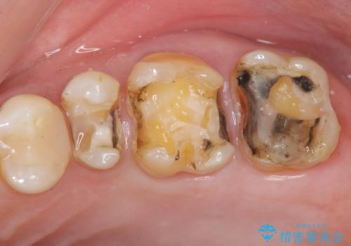 歯の神経を守る、精密な虫歯治療の実践の治療中