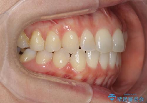 前歯のがたつきをしっかり治すマウスピース矯正の治療後