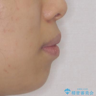 閉じにくい唇 抜歯矯正でスッキリした横顔にの治療前(顔貌)