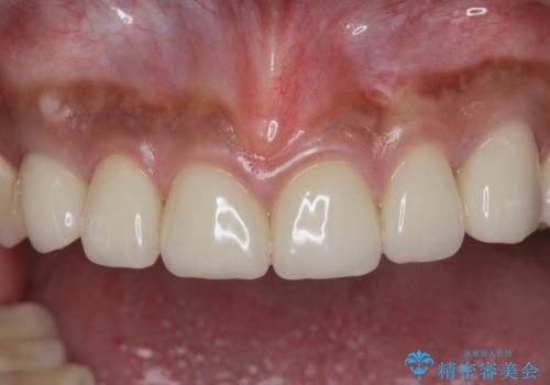 [ セラミック治療 ]   虫歯でつぎはぎになってしまった歯をきれいにしたいの治療後