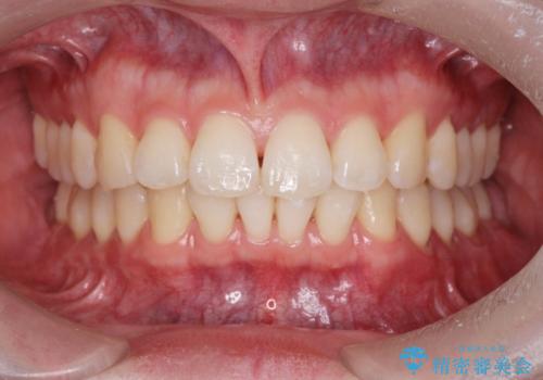 ワイヤー矯正がしたいの症例 治療後