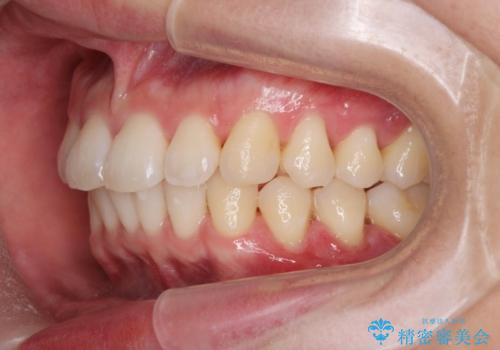 ワイヤー矯正がしたいの治療後