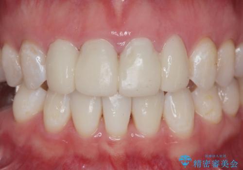 仮歯のまま放置していた前歯をセラミックにの治療前
