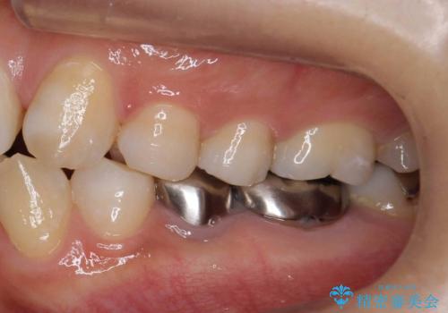 歯の高さがない 被せ物のやりなおしの治療前