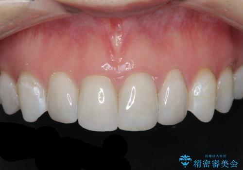 仮歯のまま放置していた前歯をセラミックにの症例 治療後