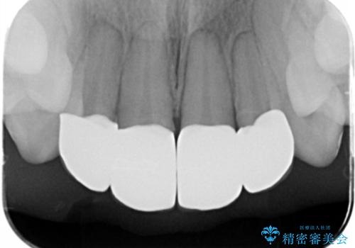 仮歯のまま放置していた前歯をセラミックにの治療後