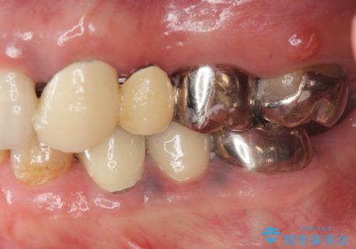 銀歯の見た目を改善、ジルコニア製セラミックブリッジの治療前