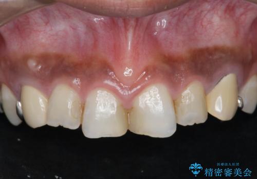 [ セラミック治療 ]   虫歯でつぎはぎになってしまった歯をきれいにしたいの症例 治療前