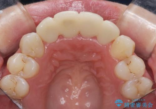 仮歯のまま放置していた前歯をセラミックにの治療前