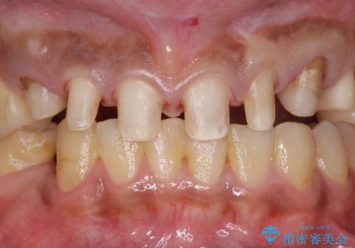 [ セラミック治療 ]   虫歯でつぎはぎになってしまった歯をきれいにしたいの治療中