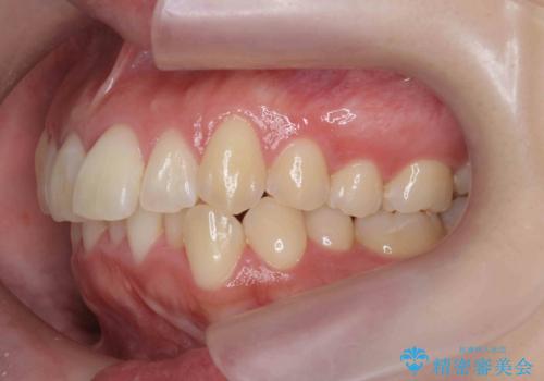 [ インビザライン矯正 ]  マウスピースで治す前歯のがたつきの治療前
