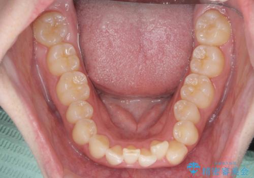 [ インビザライン矯正 ]  マウスピースで治す前歯のがたつきの治療前