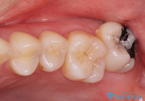 奥歯の黒いのが気になる。の症例 治療前