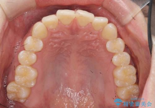 ワイヤー矯正がしたいの治療前