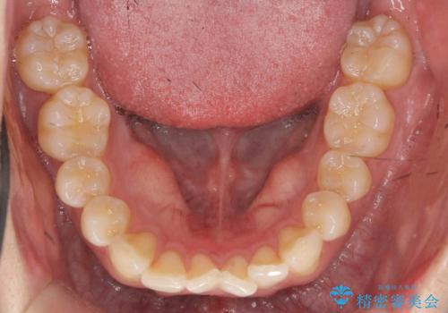 ワイヤー矯正がしたいの治療前