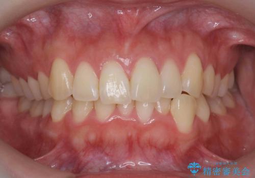 [ インビザライン矯正 ]  マウスピースで治す前歯のがたつきの症例 治療前