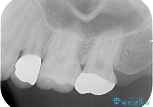 保険で被せた白い被せ物をやりかえたい。の治療後