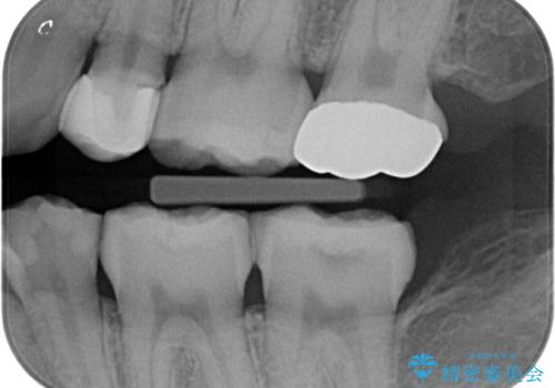保険で被せた白い被せ物をやりかえたい。の治療前