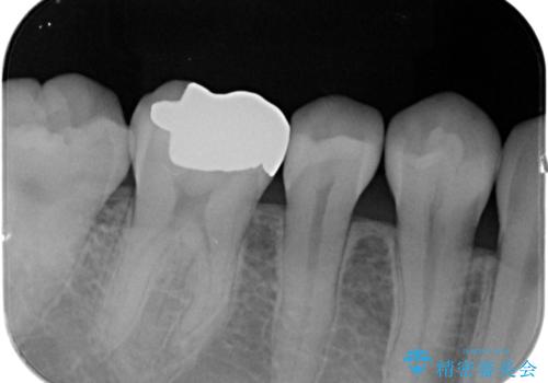 劣化した保険の詰め物部分の治療をしたい。の治療後
