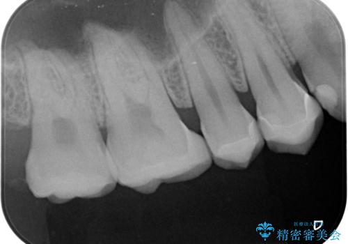 銀の詰め物をやりかえたいの治療後