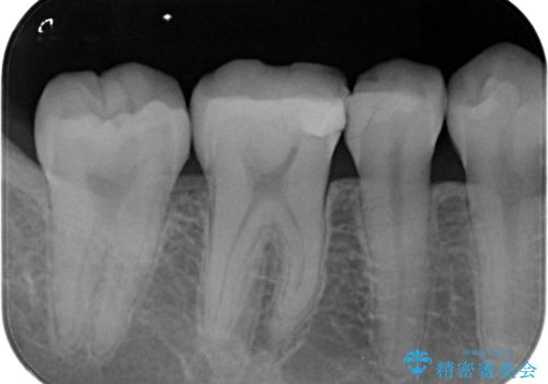 劣化した保険の詰め物部分の治療をしたい。の治療前