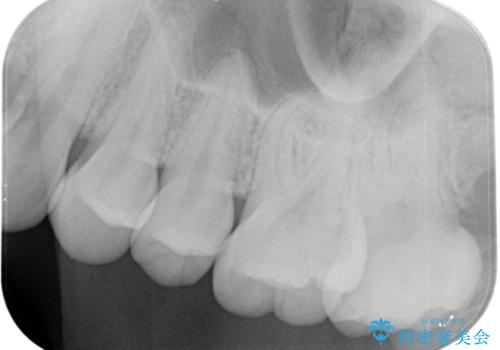 奥歯の黒いのが気になる。の治療後