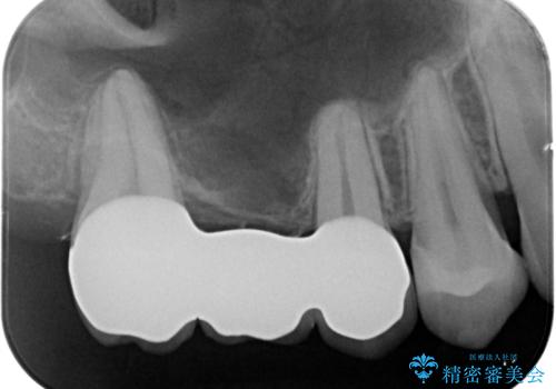 銀の詰め物を白くしたい。の治療後