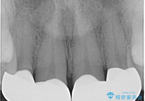 前歯をきれいな被せ物にしたい。の治療後