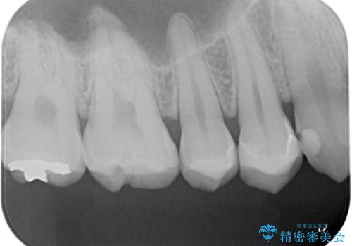 銀の詰め物をやりかえたいの治療前