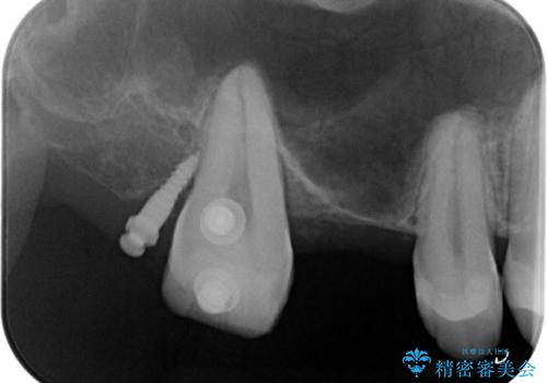 銀の詰め物を白くしたい。の治療中