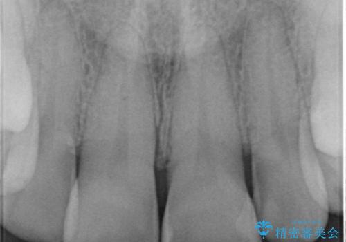 前歯をきれいな被せ物にしたい。の治療前
