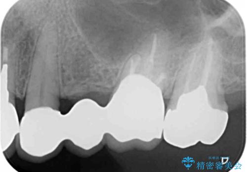 銀歯の見た目を改善、ジルコニア製セラミックブリッジの治療後