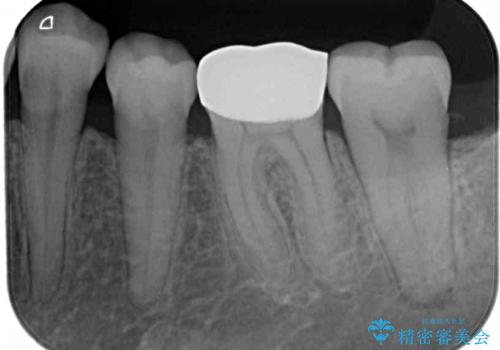 口を開けたときに目立つ銀歯 オールセラミック治療の治療前